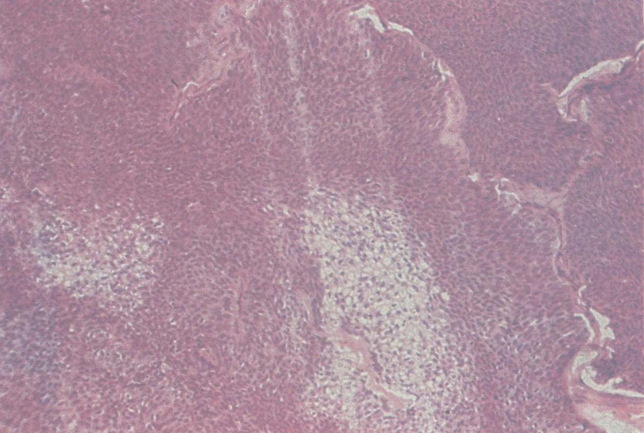解析粉瘤——皮脂腺囊肿 - 知乎
